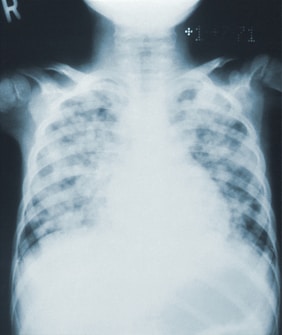 An X-ray image showing the upper torso, focusing on the ribcage, spine, and lungs. The bones appear in varying shades of white and gray against a black background.