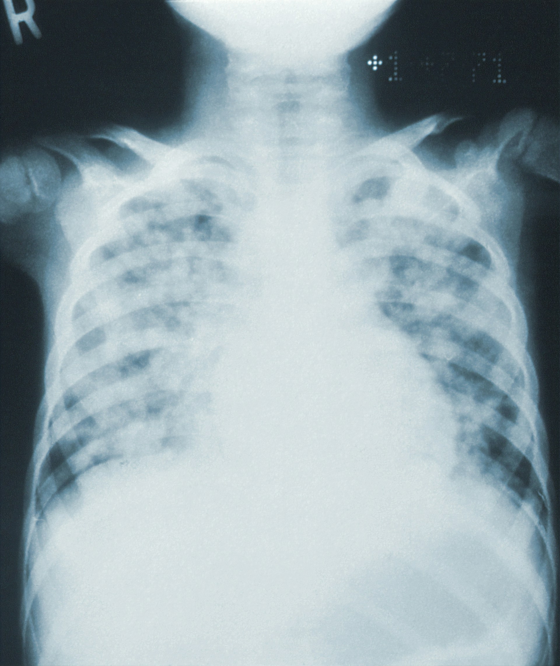 X-Ray Film Recovery