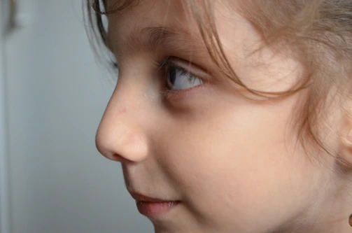 Side profile showing facial growth improvement in a pediatric patient