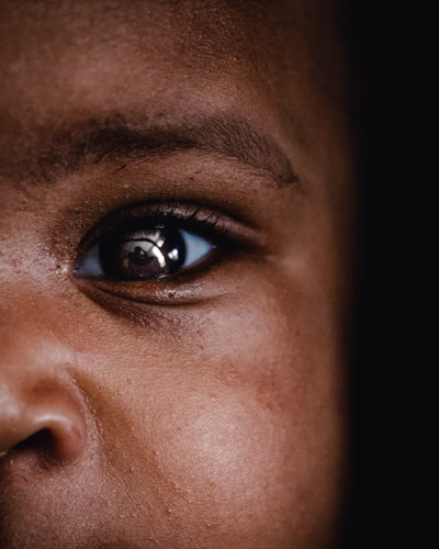 Eye close-up glaucoma