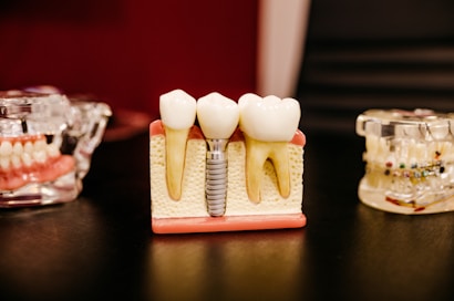 Dental Implant Cost in Greater Noida