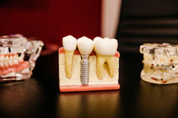 dental implant model with teeth