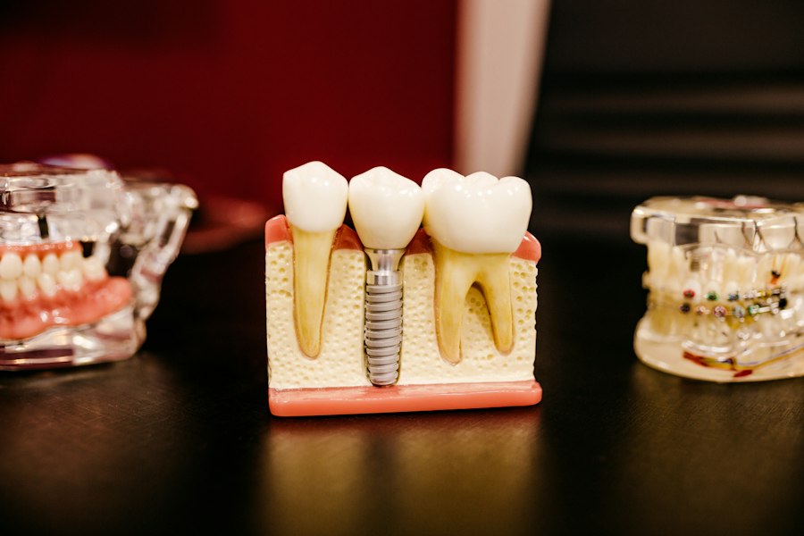 Modelo de implante dentário ao lado de dentes