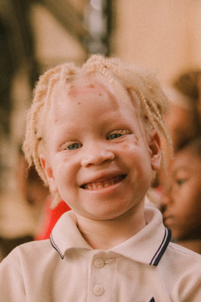 Альбинизмом страдают. Альбинос негроидной расы. Альбинизм 1в. Глазокожный альбинизм. Тотальный альбинизм.