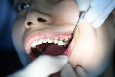 Braces treatment charges in Greater Noida