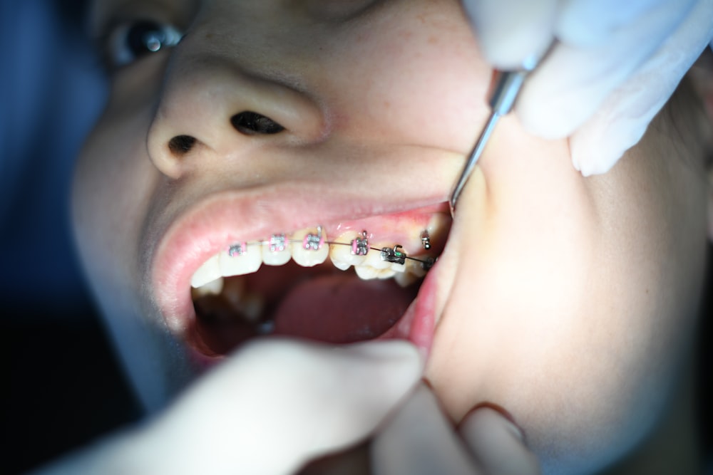 Persona con brackets dentales plateados