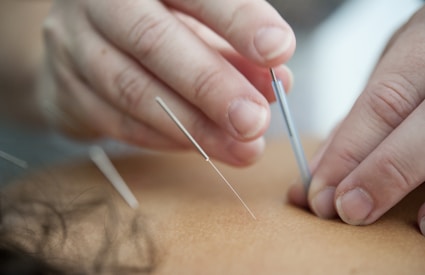 Close-up of hands performing acupuncture on a patient's back.