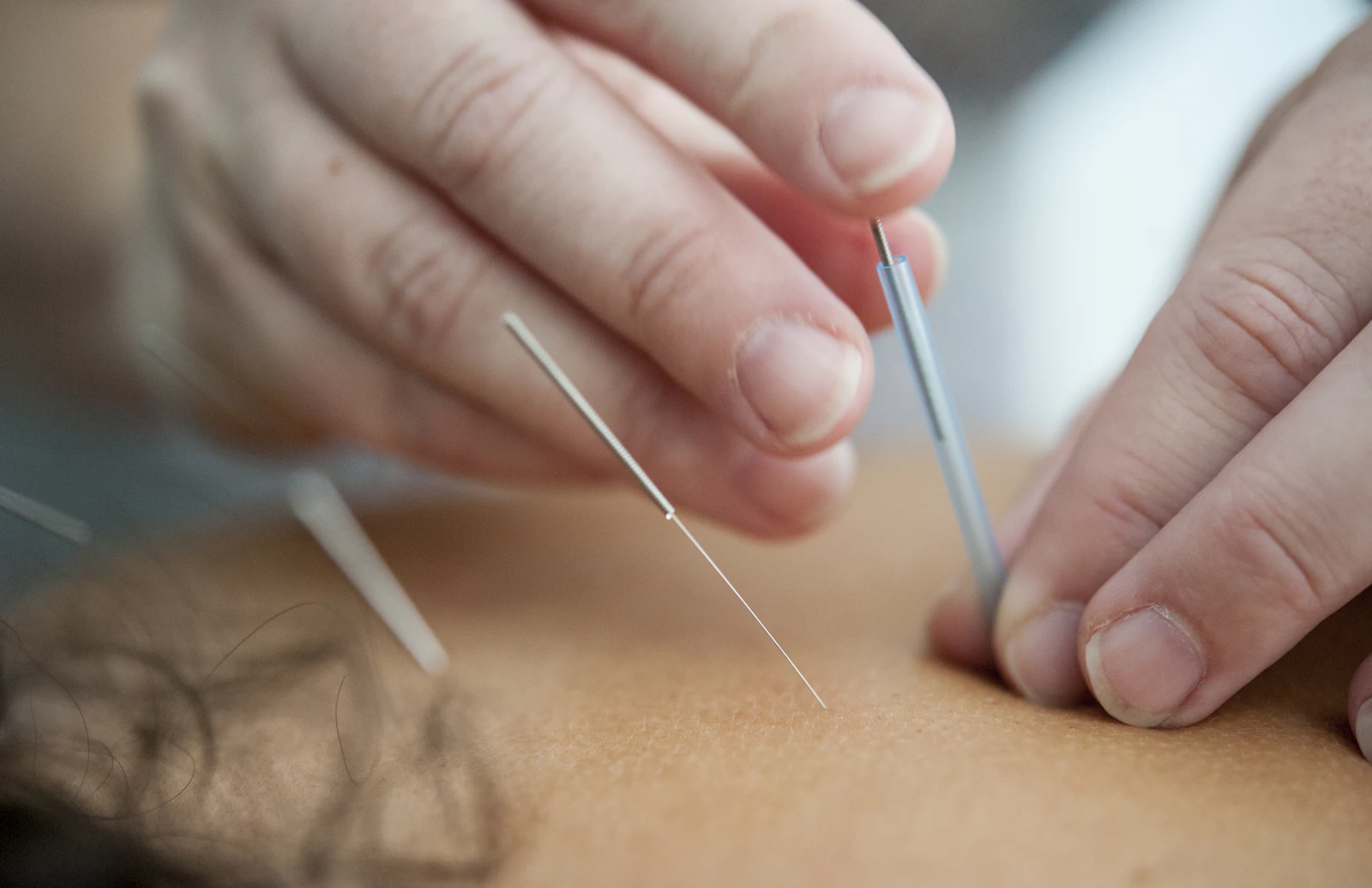 Acupuncturist's hands holding a fine silver needle in soft light