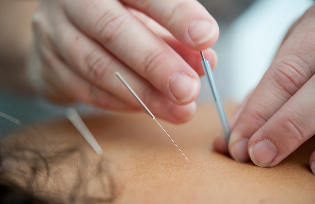 Acupuncture for Pain Relief: Find Relief in Vancouver