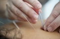 Hands inserting acupuncture needles into skin, highlighting a close-up view of a therapeutic procedure.