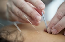 Hands inserting acupuncture needles into skin, highlighting a close-up view of a therapeutic procedure.