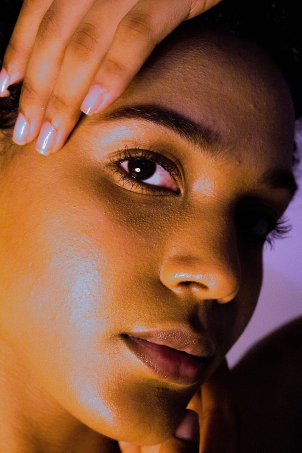 E.T. — before and after VI Peel chemical peel