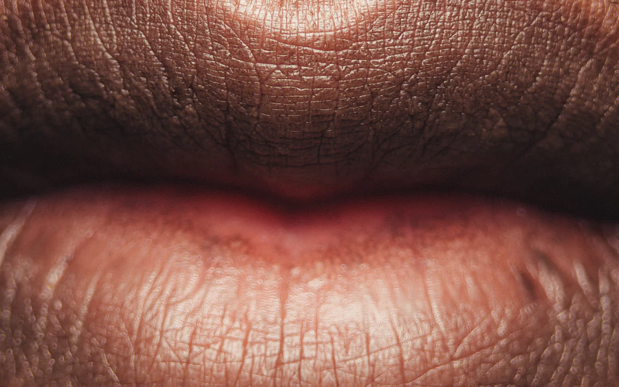 Labbra dopo il trattamento con filler