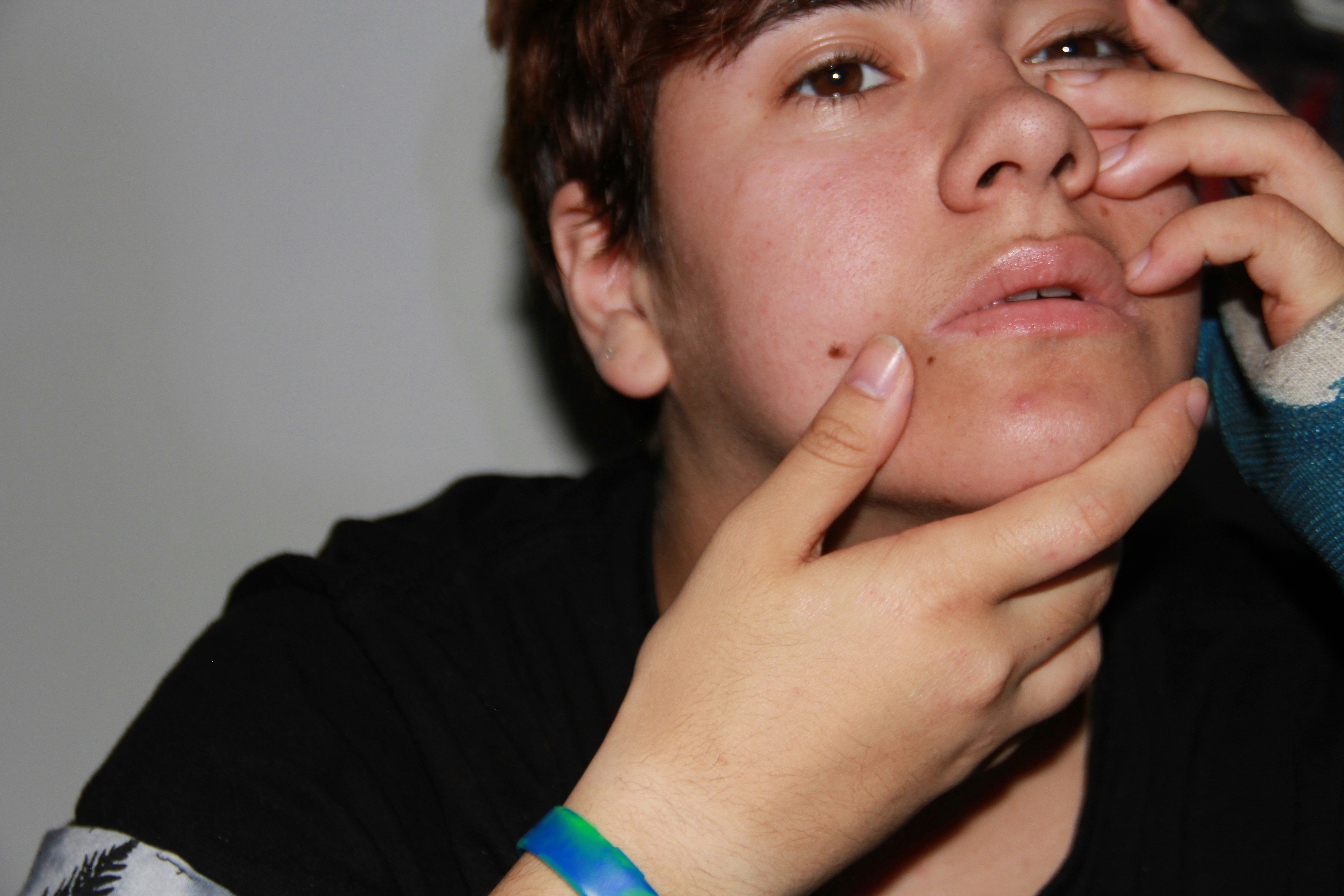 When Skin Conditions Wear Each Other's Faces: The Clinical Art of Telling Acne, Rosacea, and Eczema Apart