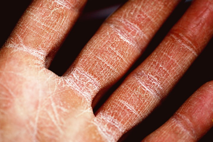 Why Does Eczema Itch?