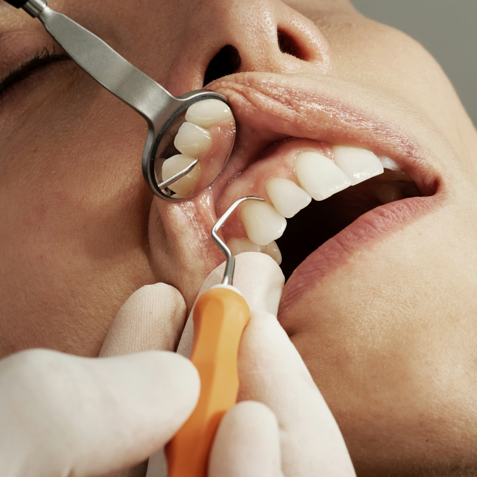 Dental Implants Antalya