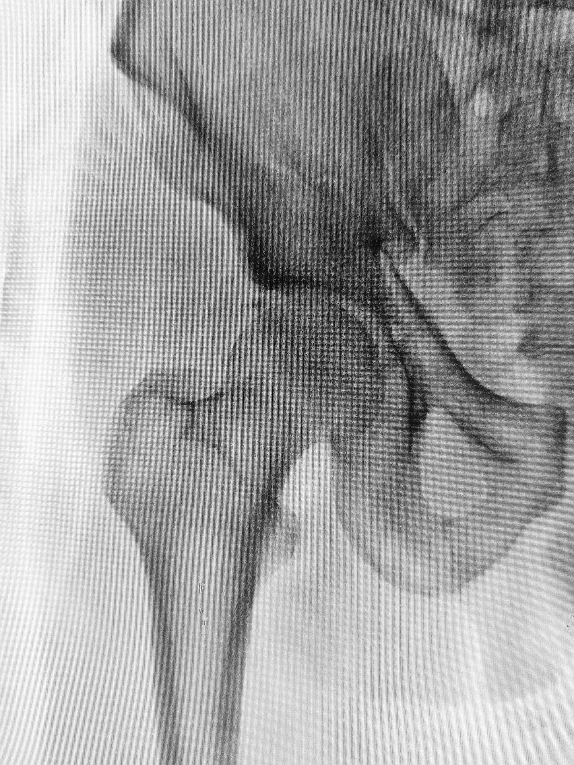 X-ray Hip Fracture 