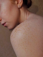 Controllo nei - prevenzione melanoma