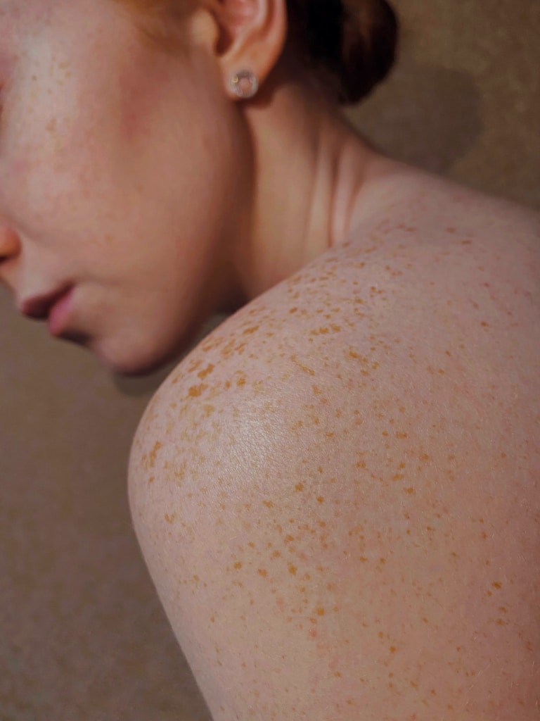 topless woman with brown hair and freckles indicating prior skin barrier damage