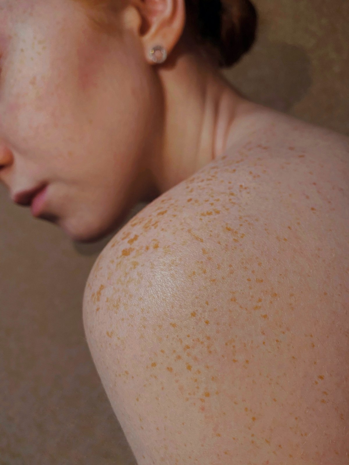 Actinic Keratosis procedure planning image