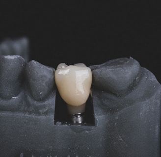 Dental Implant supported Dental Crown