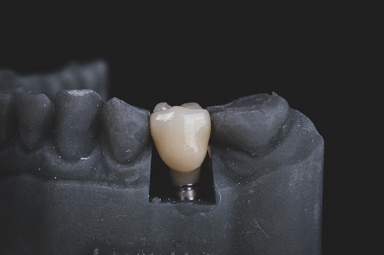 Dental Implant supported Dental Crown