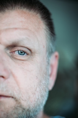 Close-up of a man with patchy beard spots on his cheeks