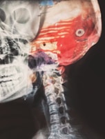 A detailed x-ray image of a human skull and neck with an overlay of bright red and orange colors highlighting muscular and tissue structures. The skeletal structure, including the vertebrae in the neck, is visible.