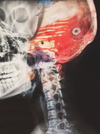 A detailed x-ray image of a human skull and neck with an overlay of bright red and orange colors highlighting muscular and tissue structures. The skeletal structure, including the vertebrae in the neck, is visible.