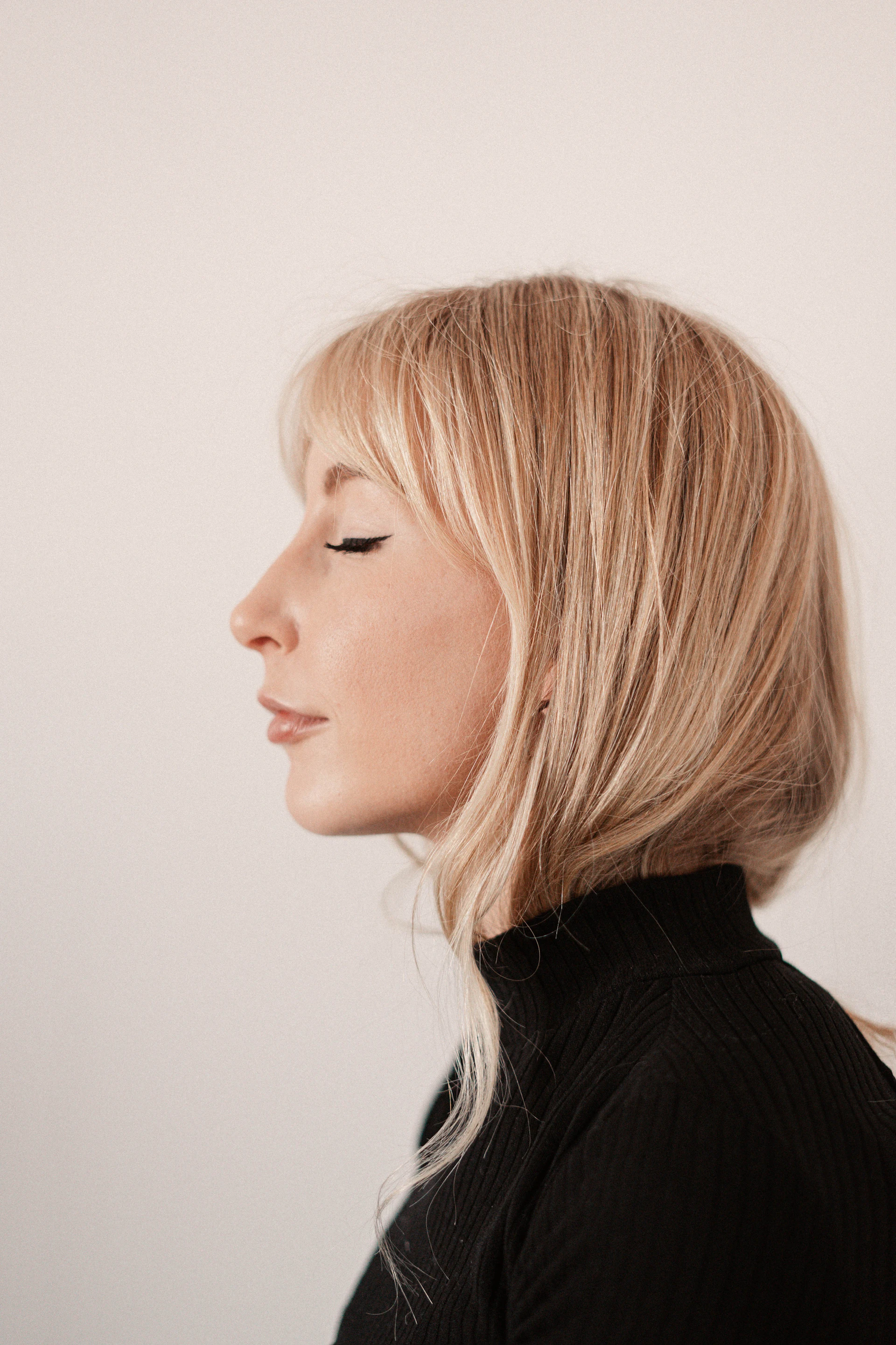 Elena M. before Fractional Laser Resurfacing