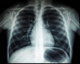 A black and white X-ray image of the human chest region showing the ribcage, spine, and part of the shoulder blades. The lungs and heart are faintly visible within the ribcage structure.