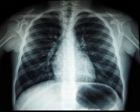 A black and white X-ray image of the human chest region showing the ribcage, spine, and part of the shoulder blades. The lungs and heart are faintly visible within the ribcage structure.