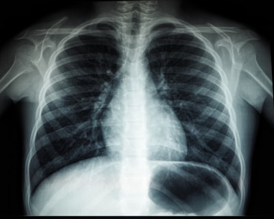 A black and white X-ray image of the human chest region showing the ribcage, spine, and part of the shoulder blades. The lungs and heart are faintly visible within the ribcage structure.