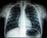 A black and white X-ray image of the human chest region showing the ribcage, spine, and part of the shoulder blades. The lungs and heart are faintly visible within the ribcage structure.