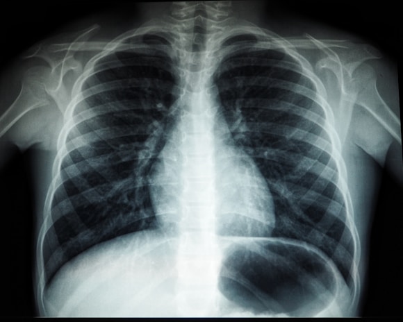 A black and white X-ray image of the human chest region showing the ribcage, spine, and part of the shoulder blades. The lungs and heart are faintly visible within the ribcage structure.