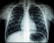 A black and white X-ray image of the human chest region showing the ribcage, spine, and part of the shoulder blades. The lungs and heart are faintly visible within the ribcage structure.