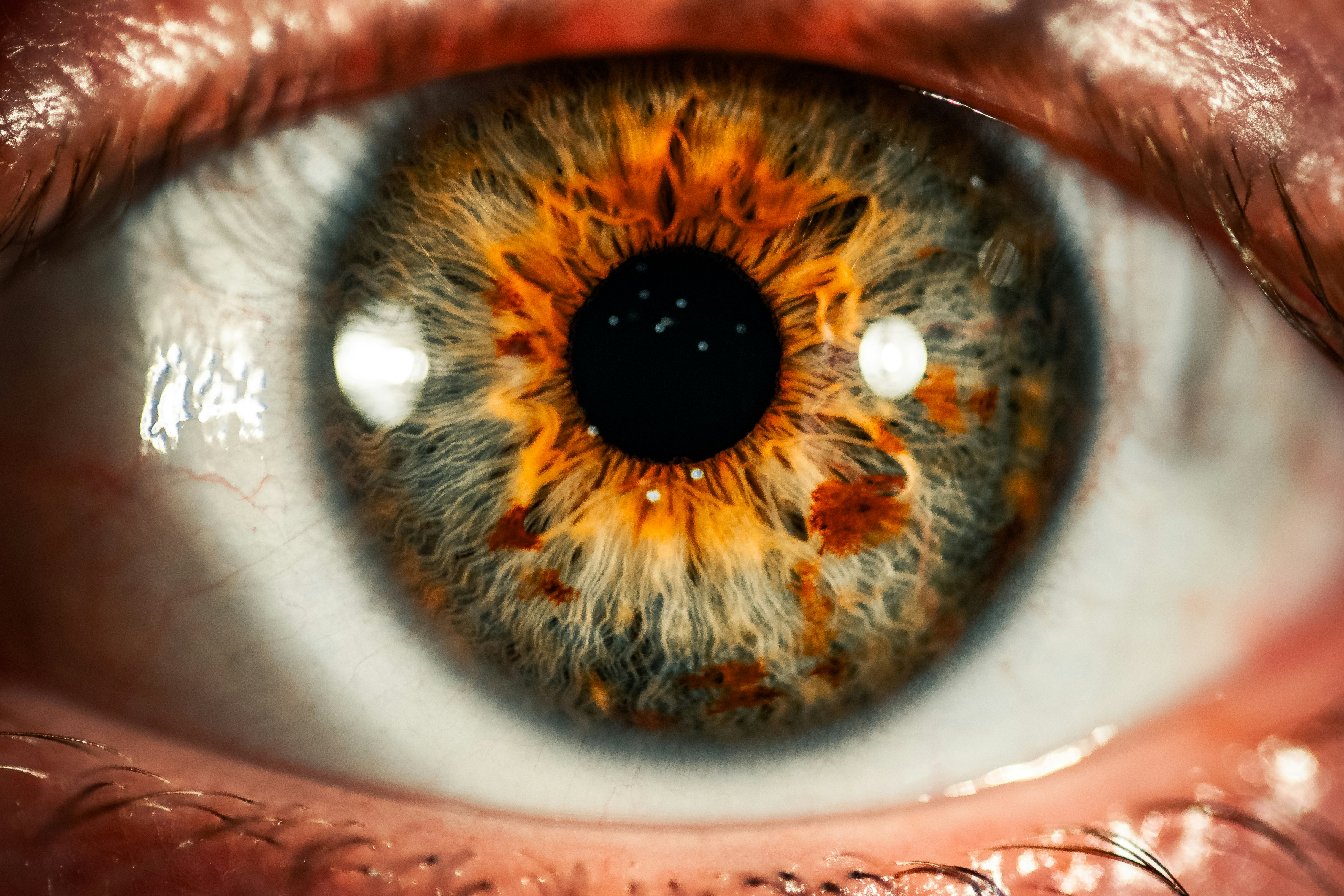 Imagine cu un ochi care sugerează complicația diabetului cu retinoatia diabetică.