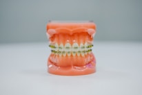 A realistic dental model displaying a full set of teeth fitted with orthodontic braces. The model is placed against a plain background, highlighting the intricate details of the braces and the gums.