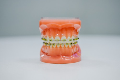 A realistic dental model displaying a full set of teeth fitted with orthodontic braces. The model is placed against a plain background, highlighting the intricate details of the braces and the gums.