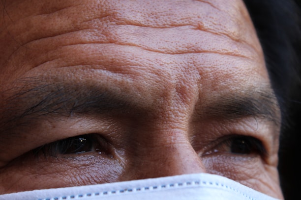 Before and after comparison of a client's forehead lines treatment.