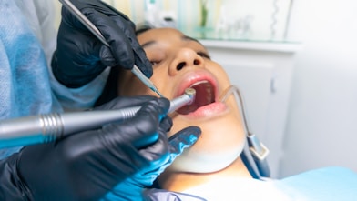 Dental Fillings