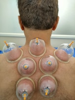 A person undergoing a cupping therapy session, with multiple suction cups placed on their upper back. The cups create a vacuum effect, drawing the skin into the cups. The skin is slightly reddened from the suction.