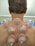 A person undergoing a cupping therapy session, with multiple suction cups placed on their upper back. The cups create a vacuum effect, drawing the skin into the cups. The skin is slightly reddened from the suction.