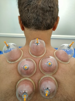 A person undergoing a cupping therapy session, with multiple suction cups placed on their upper back. The cups create a vacuum effect, drawing the skin into the cups. The skin is slightly reddened from the suction.
