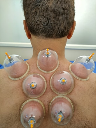 A person undergoing a cupping therapy session, with multiple suction cups placed on their upper back. The cups create a vacuum effect, drawing the skin into the cups. The skin is slightly reddened from the suction.