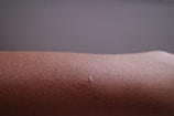 Forearm skin after genivex treatment with noticeable reduction in pigmentation.