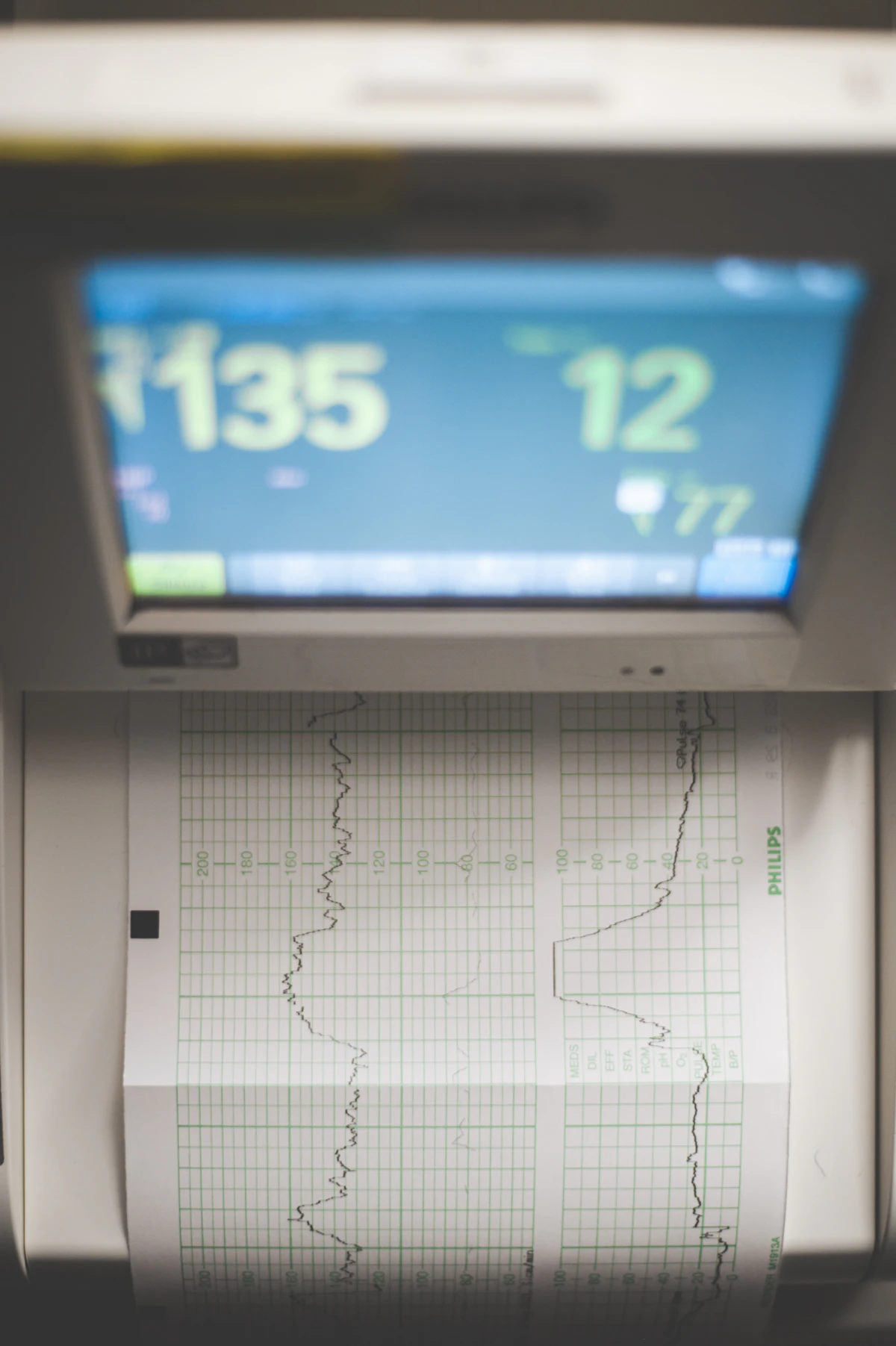 Monitor cardiaco con ECG durante monitoraggio oncologico
