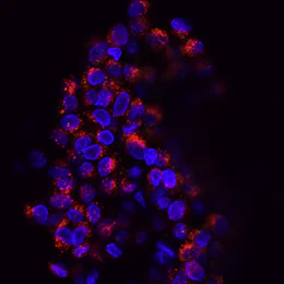FDA approves Etcamah (camizestrant) for ESR1-mutated advanced breast cancer