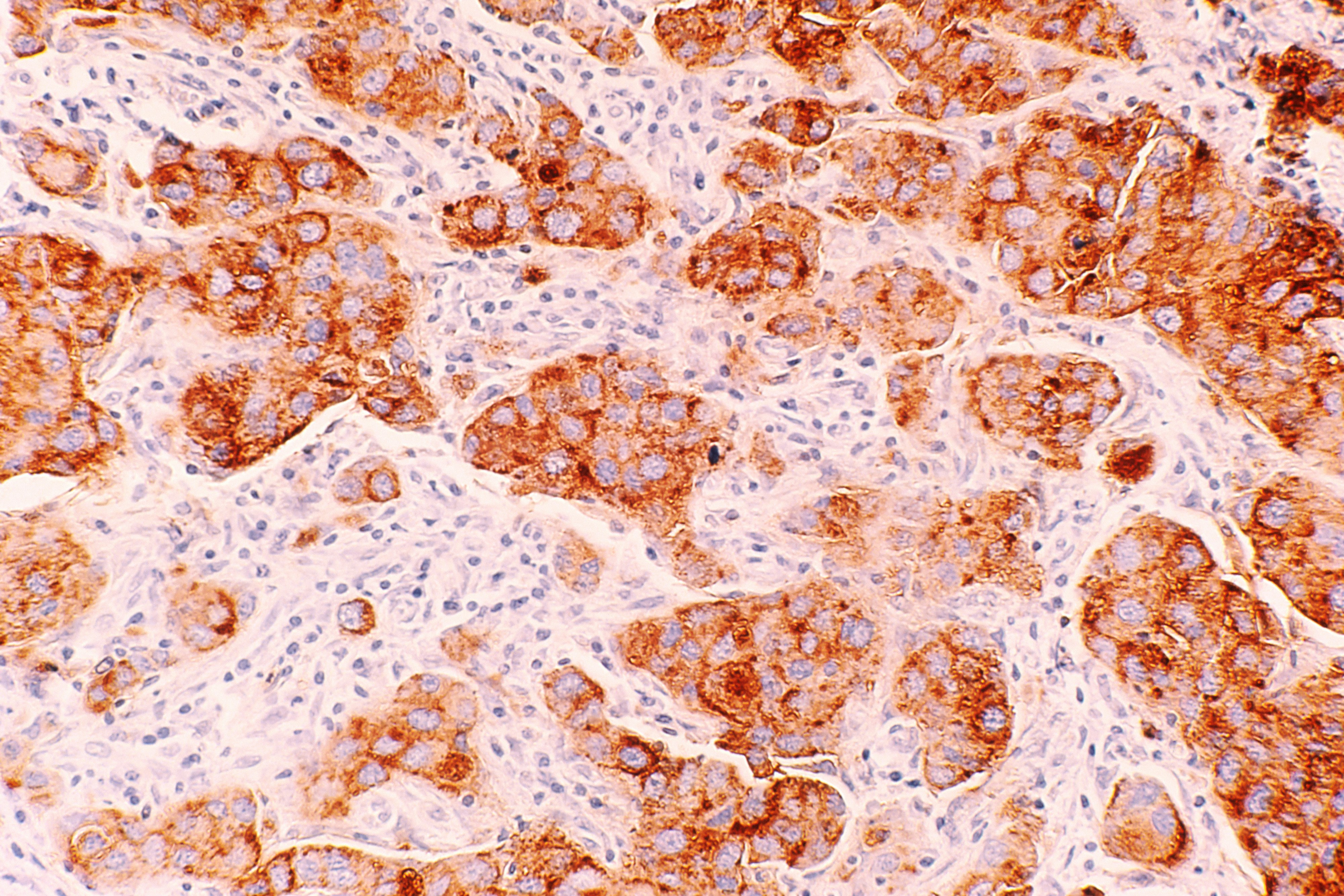 Can Oxalates Trigger Flare-Ups In Multiple Sclerosis?