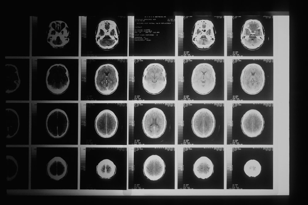 Ein Schwarz-Weiß-Foto verschiedener MRT-Bilder